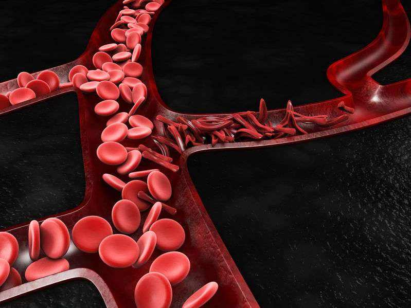 Six types of people most likely to suffer from blood clots