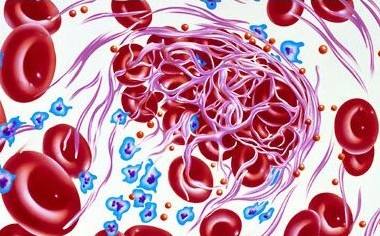 What Are The Symptoms Of Blood Clots?