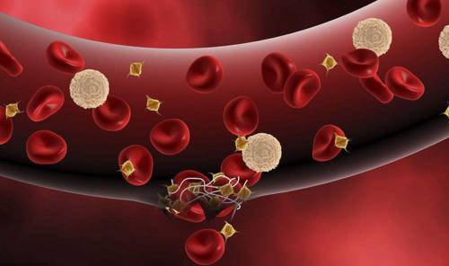 Three Ways To Treat Thrombosis