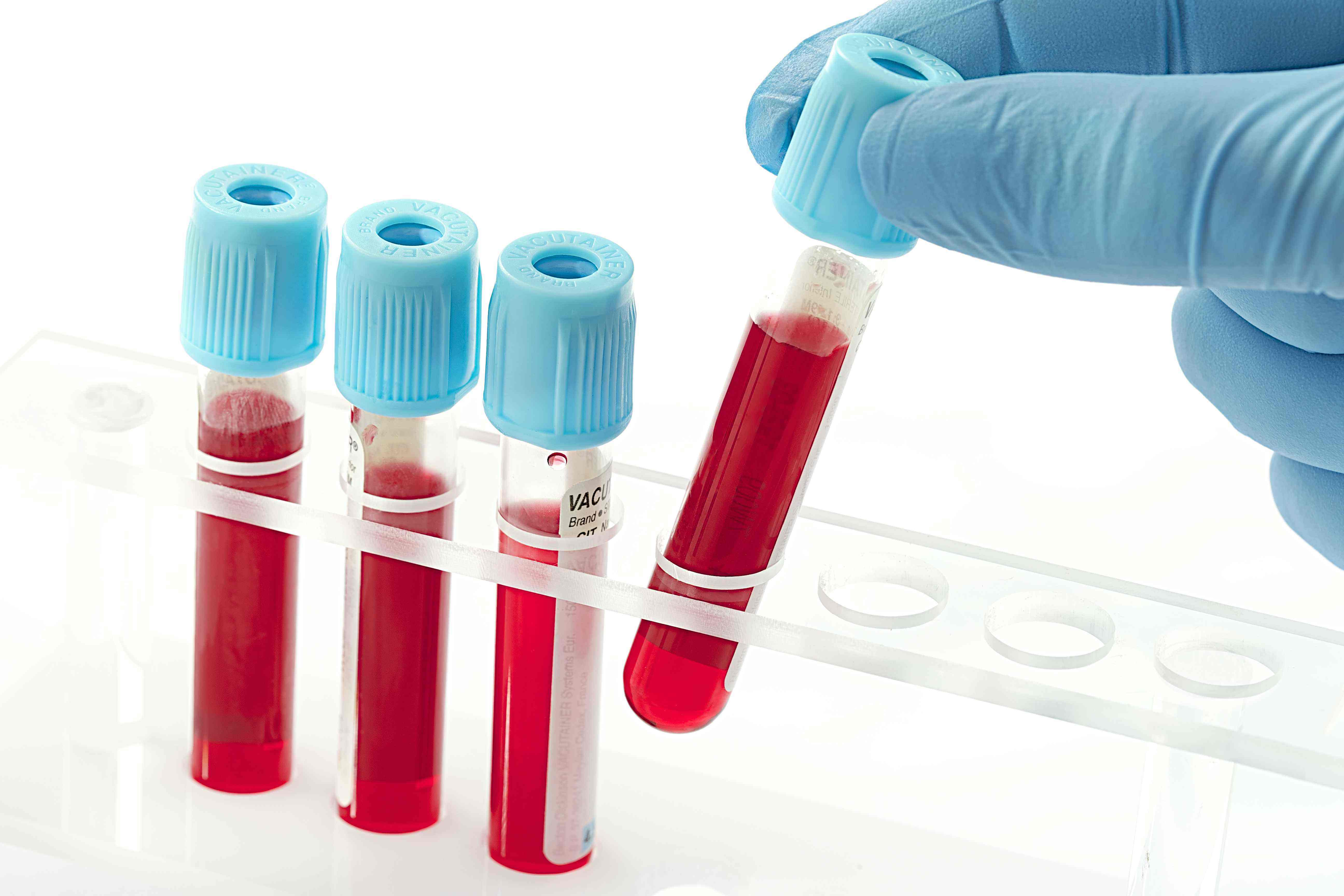 Clinical significance of PT APTT FIB test in hepatitis B patients